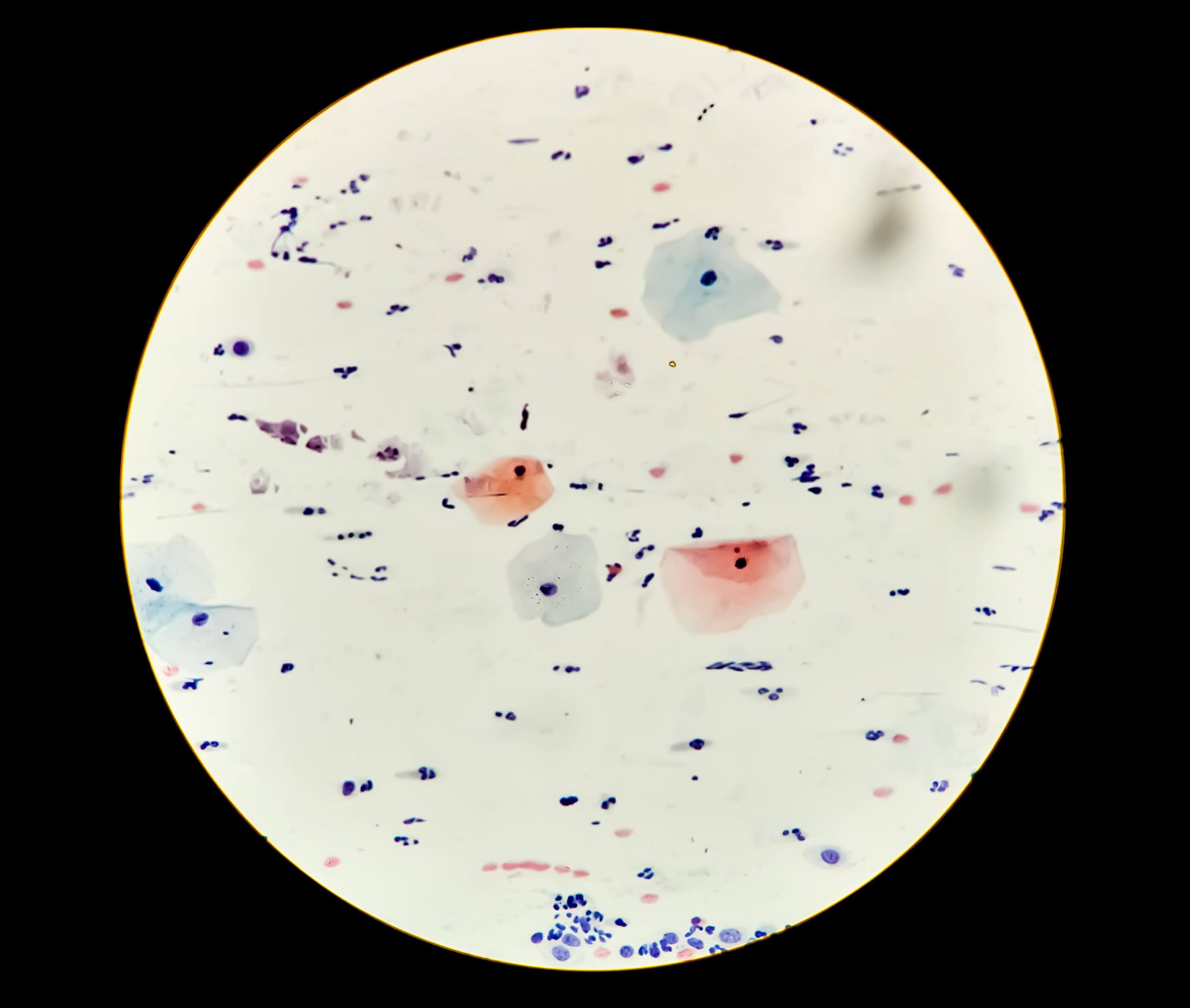 Sanofi – Skin cancer – A 67-year-old man with locally advanced basal cell carcinoma